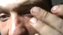 Guy picks and pulls piece of his eyeball out (removed from wtf)